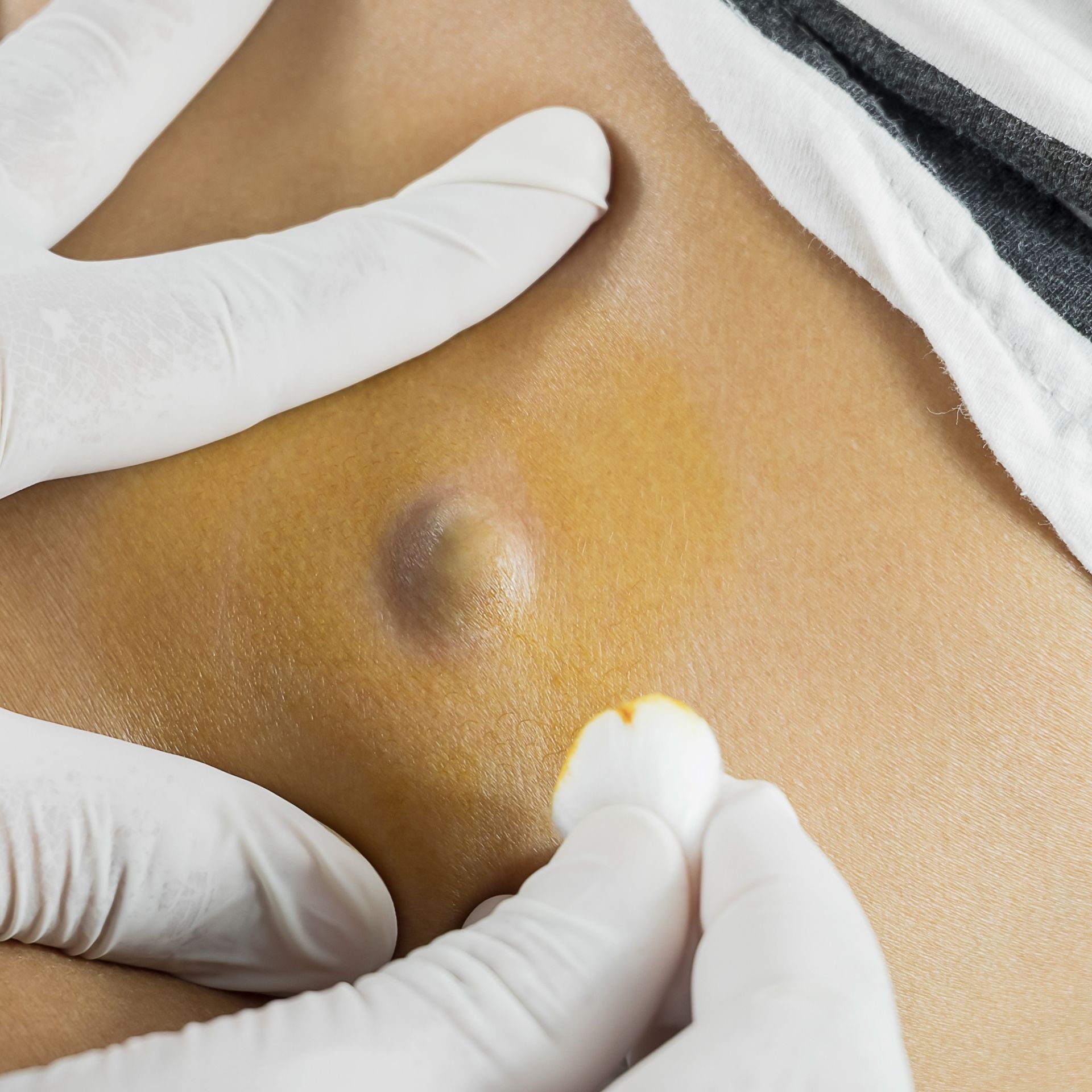 Chirurgia nano ablativa DJ MEDICAL